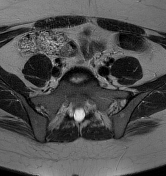 File:Broad ligament leiomyoma (Radiopaedia 81634-95516 Axial T2 1).jpg