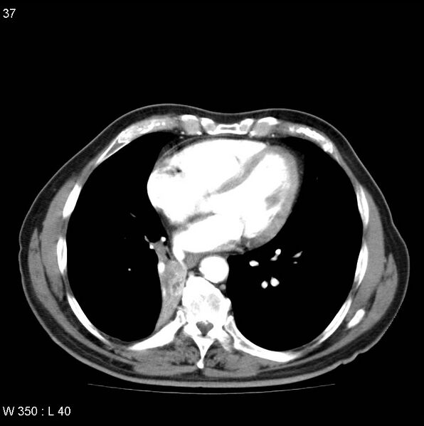 File:Bronchial carcinoid tumor with right lower lobe collapse (Radiopaedia 29060-29422 A 36).jpg