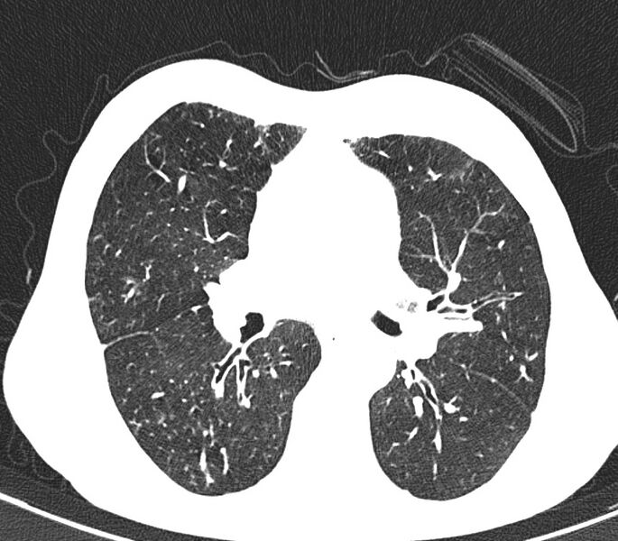 File:Bronchiolitis (Radiopaedia 24616-24887 Axial lung window 27).jpg