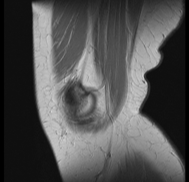 File:Bucket handle tear - medial meniscus (Radiopaedia 24900-25163 Sagittal T2 1).png