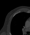 Buckle rib fractures (Radiopaedia 16349-16034 B 1).jpg