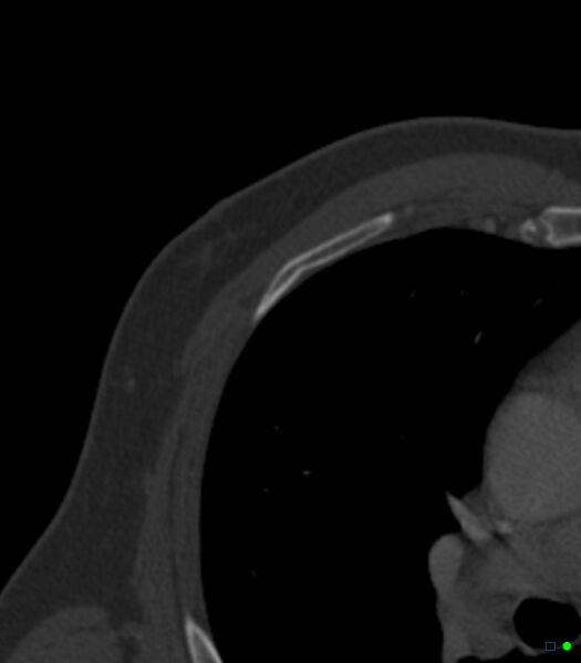 File:Buckle rib fractures (Radiopaedia 16349-16034 B 1).jpg