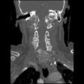 C1 anterior arch (plough) fracture - type 1 (Radiopaedia 76181-87720 Coronal bone window 48).jpg