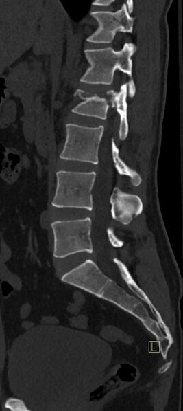 File:Calcaneal fractures with associated L2 burst fracture (Radiopaedia 71671-82493 Sagittal bone window 42).jpg