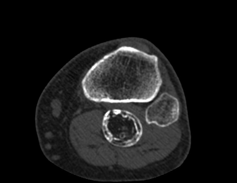File:Calcified hematoma - popliteal fossa (Radiopaedia 63938-72763 Axial bone window 70).jpg