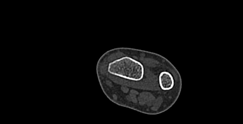 File:Calcifying aponeurotic fibroma (Radiopaedia 88423-105064 Axial bone window 1).jpg