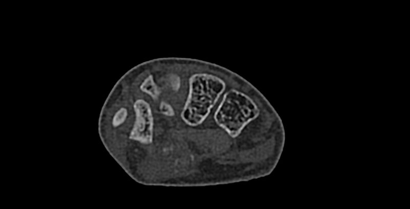 File:Calcifying aponeurotic fibroma (Radiopaedia 88423-105064 Axial bone window 104).jpg