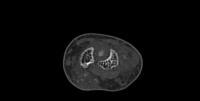 File:Calcifying aponeurotic fibroma (Radiopaedia 88423-105064 Axial bone window 60).jpg