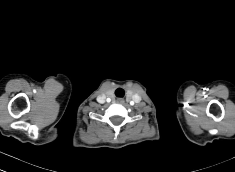 File:Cannonball metastases from breast cancer (Radiopaedia 91024-108569 A 4).jpg