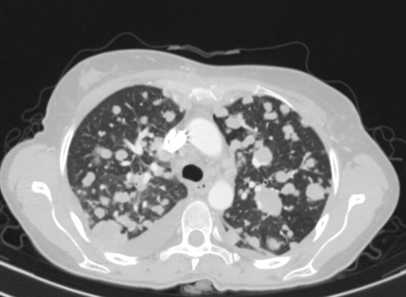 File:Cannonball metastases from breast cancer (Radiopaedia 91024-108569 Axial lung window 28).jpg
