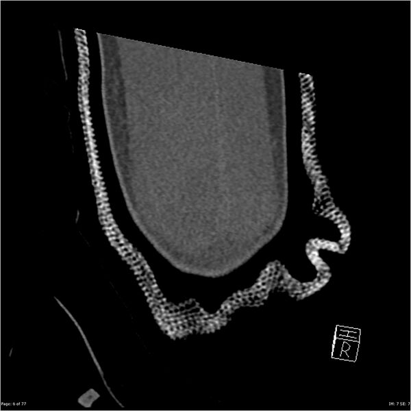 File:Capitellum fracture (Radiopaedia 23352-23426 Coronal bone window 6).jpg