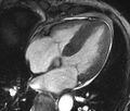 Cardiac amyloidosis (Radiopaedia 39736-42124 D 5).jpg