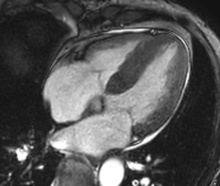 File:Cardiac amyloidosis (Radiopaedia 39736-42124 D 5).jpg