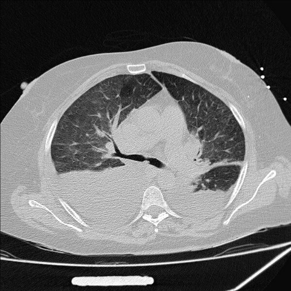 File:Cardiogenic pulmonary edema (Radiopaedia 29213-29609 Axial lung window 37).jpg