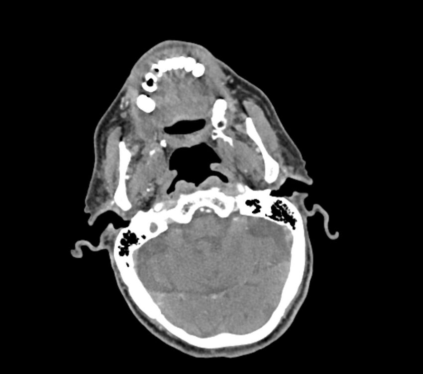 Carotid artery pseudoaneurysm (Radiopaedia 84030-99259 C 13).jpg