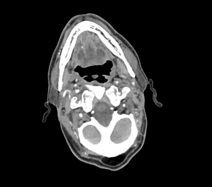 File:Carotid artery pseudoaneurysm (Radiopaedia 84030-99259 C 24).jpg