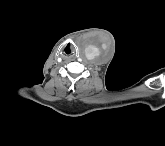File:Carotid artery pseudoaneurysm (Radiopaedia 84030-99259 C 53).jpg