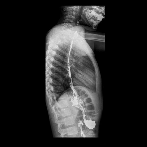 File:Caustic esophageal stricture (Radiopaedia 72422-82955 Lateral projection 1).JPEG