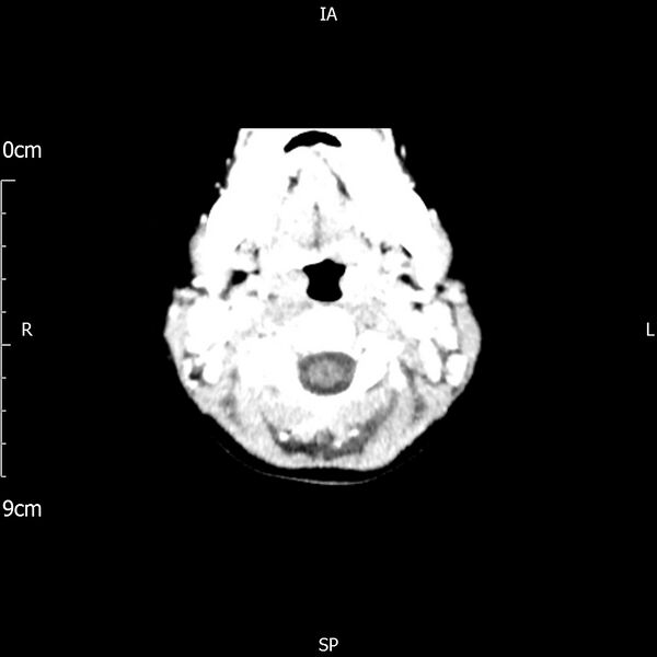 File:Cavernous sinus thrombosis (Radiopaedia 79414-92510 Axial Brain 23).jpg