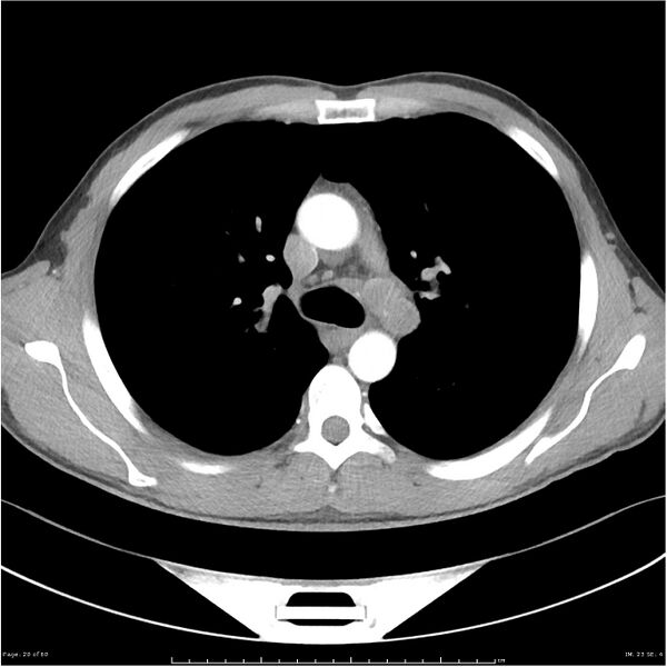 File:Cavitating lung cancer (Radiopaedia 25796-25945 C+ arterial phase 20).jpg