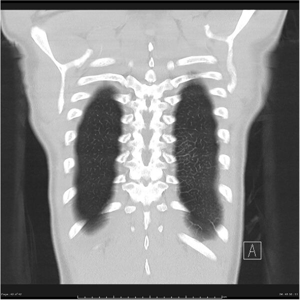 File:Cavitating lung cancer (Radiopaedia 25796-25945 lung window 40).jpg