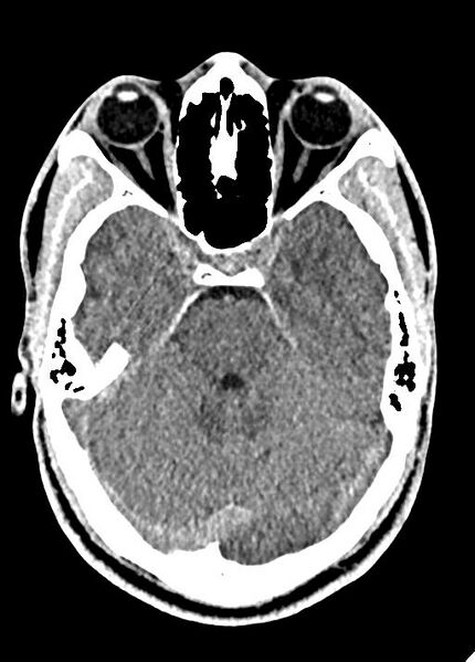 File:Cavum septum pellucidum and cavum vergae (Radiopaedia 77797-90060 Axial Brain Window 34).jpg