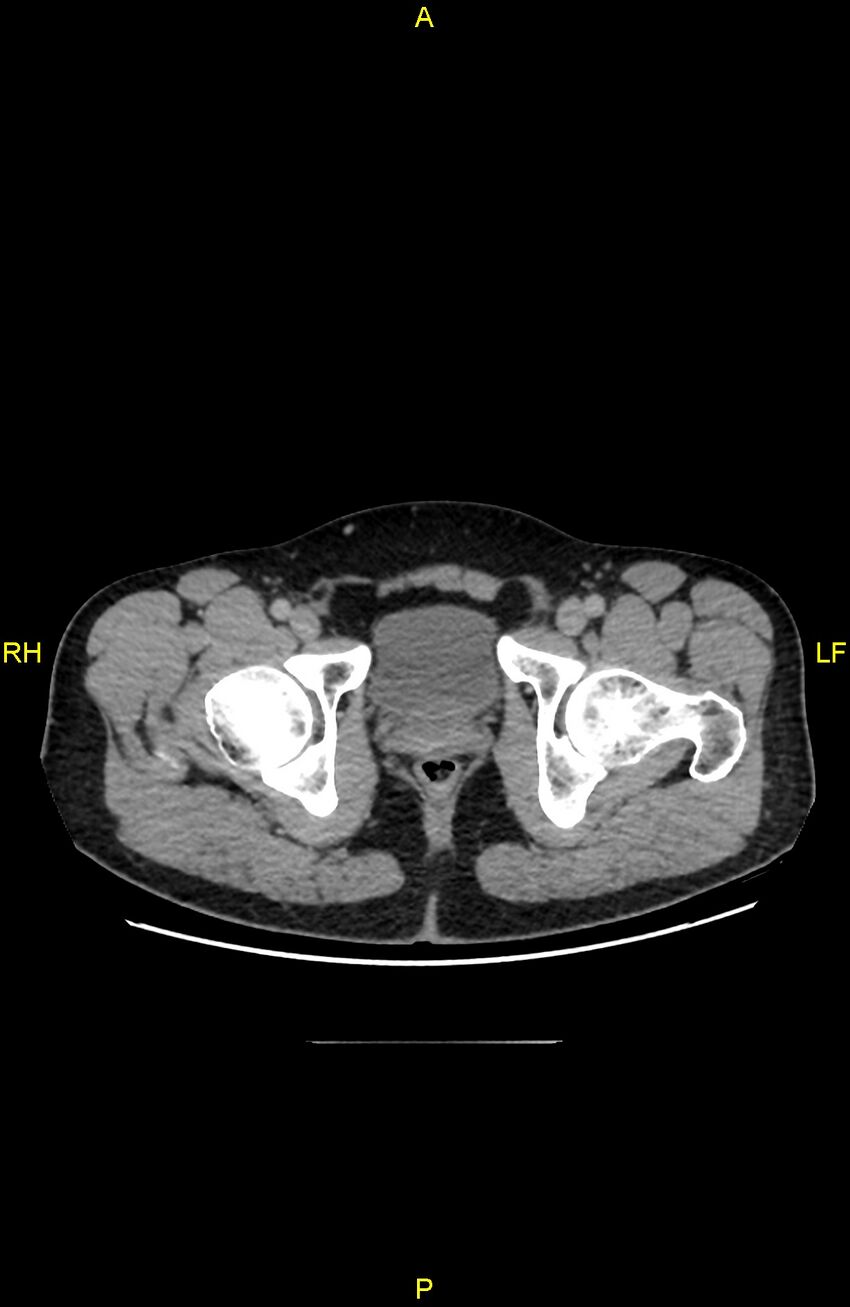 Cecal epiploic appendagitis (Radiopaedia 86047-102164 A 153).jpg