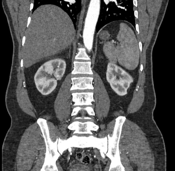 File:Celiac artery dissection (Radiopaedia 52194-58080 C 110).jpg