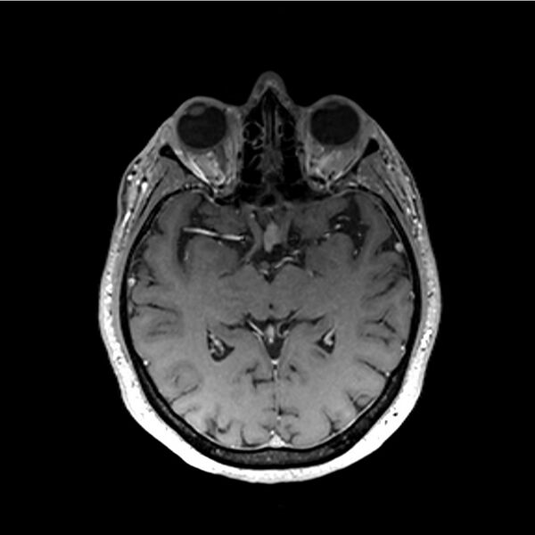 File:Central base of skull meningioma (Radiopaedia 53531-59549 Axial T1 C+ 28).jpg