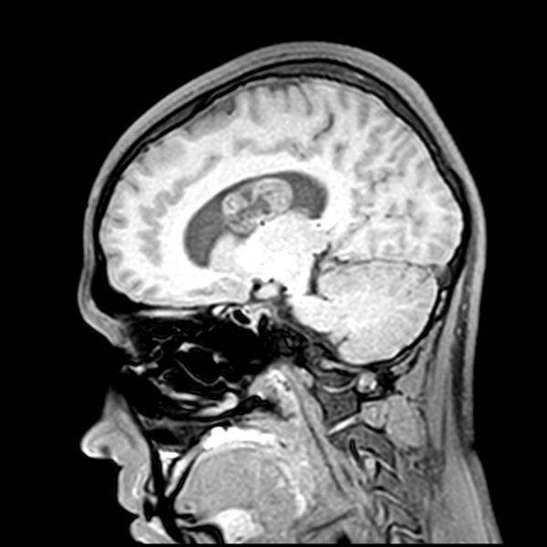 File:Central neurocytoma (Radiopaedia 79320-92380 Sagittal T1 109).jpg
