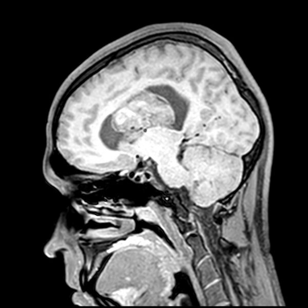 File:Central neurocytoma (Radiopaedia 79320-92380 Sagittal T1 149).jpg