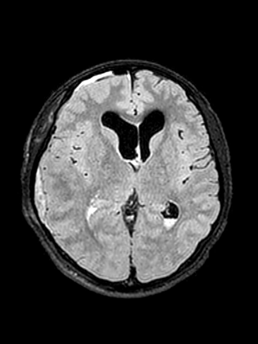Central neurocytoma (Radiopaedia 79320-92381 Axial FLAIR 89).jpg