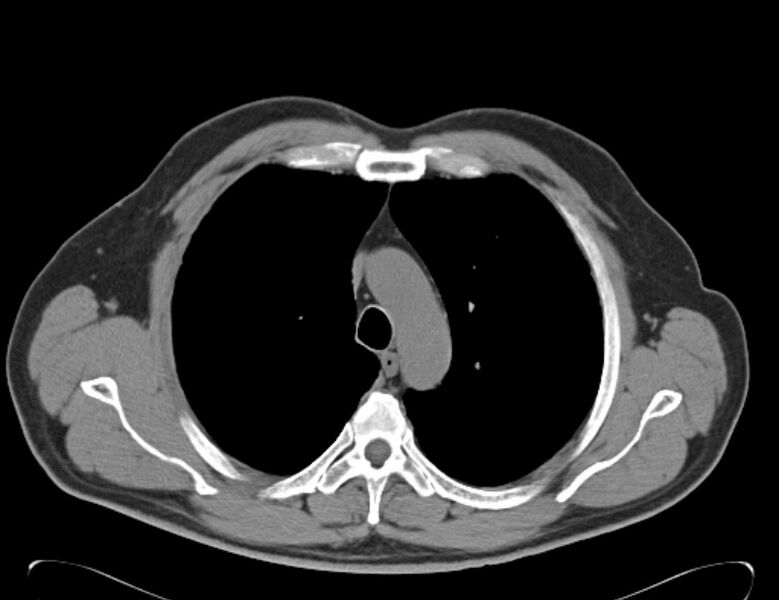 File:Centrilobular pulmonary emphysema (Radiopaedia 26808-26971 Axial non-contrast 12).jpg