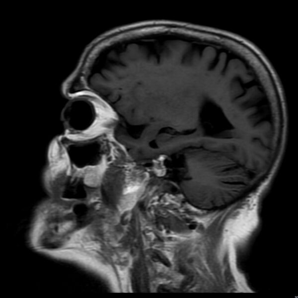 File:Cerebellar ataxia with neuropathy and vestibular areflexia syndrome (CANVAS) (Radiopaedia 74283-85159 Sagittal FLAIR 7).jpg