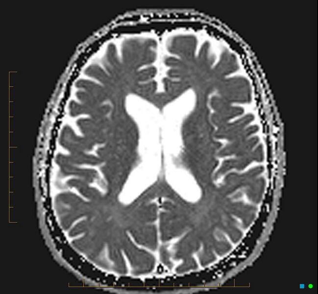 File:Cerebellar gangliocytoma (Radiopaedia 65377-74422 Axial ADC 23).jpg
