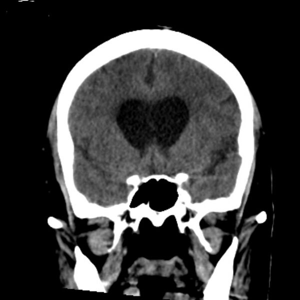 File:Cerebellar hemorrhage causing obstructive hydrocephalus (Radiopaedia 33989-35207 Coronal non-contrast 21).jpg