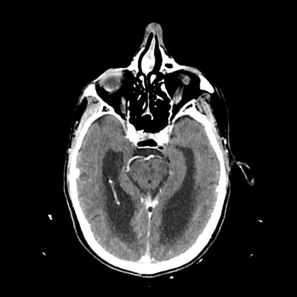 File:Cerebellar metastasis - lung tumor (Radiopaedia 69317-79145 Axial with contrast 17).jpg
