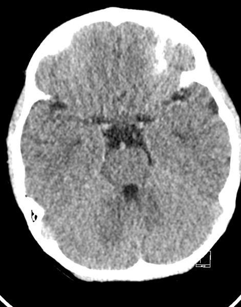 File:Cerebellar stroke (Radiopaedia 32202-33149 Axial non-contrast 7).png