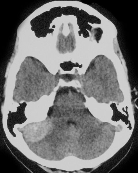 File:Cerebellopontine angle meningioma (Radiopaedia 2597-6294 Axial non-contrast 1).jpg