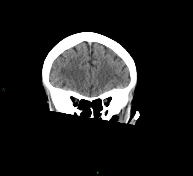 File:Cerebral amyloid angiopathy-associated lobar intracerebral hemorrhage (Radiopaedia 58378-65516 Coronal non-contrast 46).jpg