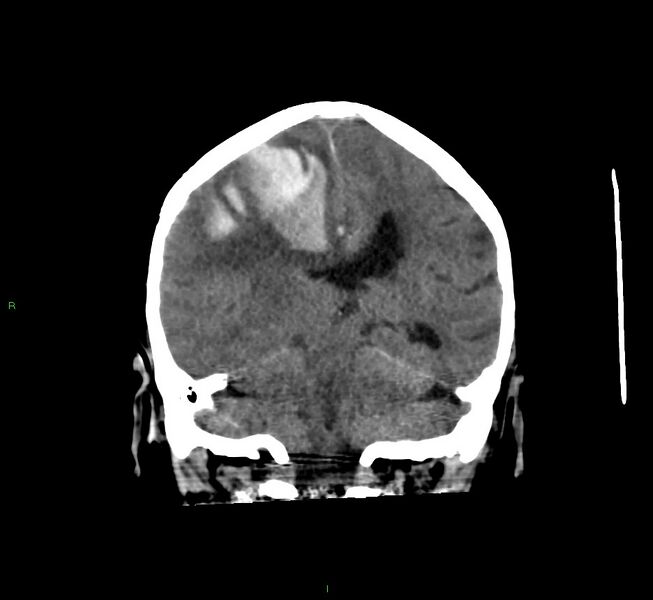 File:Cerebral amyloid angiopathy-associated lobar intracerebral hemorrhage (Radiopaedia 58560-65723 Coronal non-contrast 31).jpg