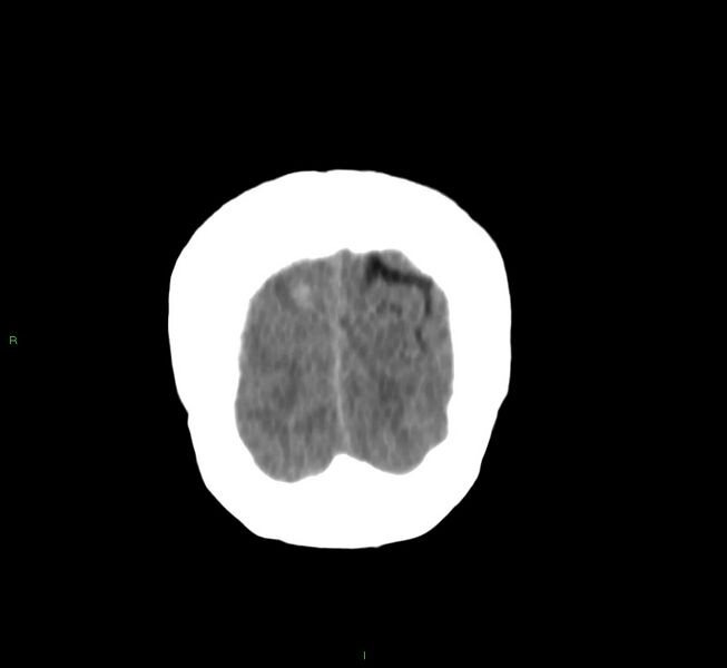 File:Cerebral amyloid angiopathy-associated lobar intracerebral hemorrhage (Radiopaedia 58751-65972 Coronal non-contrast 7).jpg