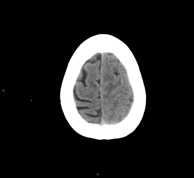 File:Cerebral amyloid angiopathy-associated lobar intracerebral hemorrhage (Radiopaedia 58754-65975 Axial non-contrast 16).jpg