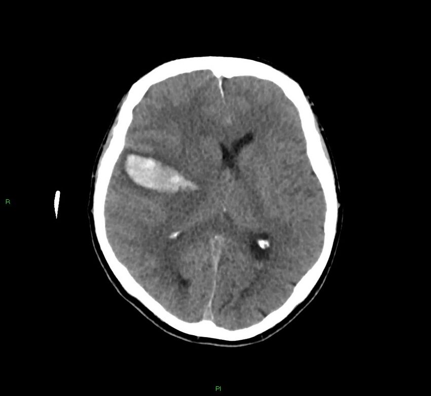 Cerebral amyloid angiopathy-associated lobar intracerebral hemorrhage (Radiopaedia 58756-65977 Axial non-contrast 27).jpg