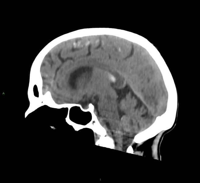 File:Cerebral amyloid angiopathy-associated lobar intracerebral hemorrhage (Radiopaedia 58758-65980 C 27).jpg