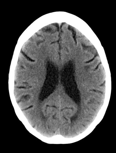 File:Cerebral aneurysm with rupture (Radiopaedia 29933-30457 Axial non-contrast 16).jpg