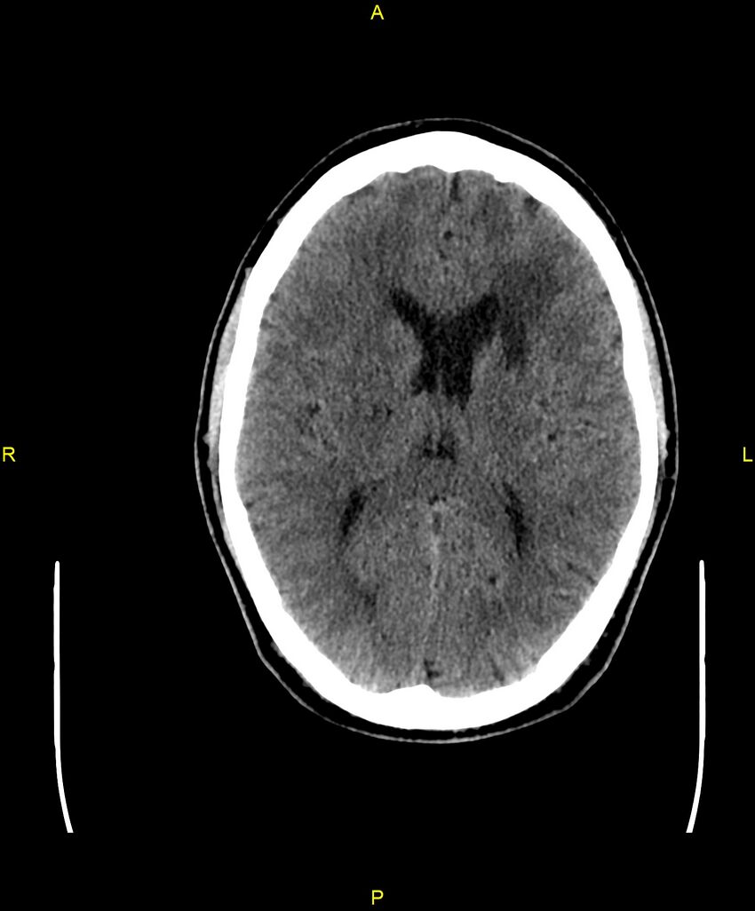 Cerebral autosomal dominant arteriopathy with subcortical infarcts and leukoencephalopathy (CADASIL) (Radiopaedia 86108-102051 Axial non-contrast 61).jpg