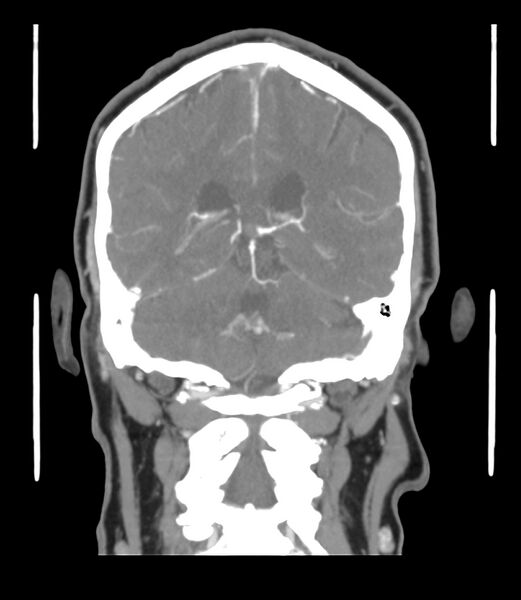 File:Cerebral dural venous sinus thrombosis (Radiopaedia 86514-102576 B 48).jpg