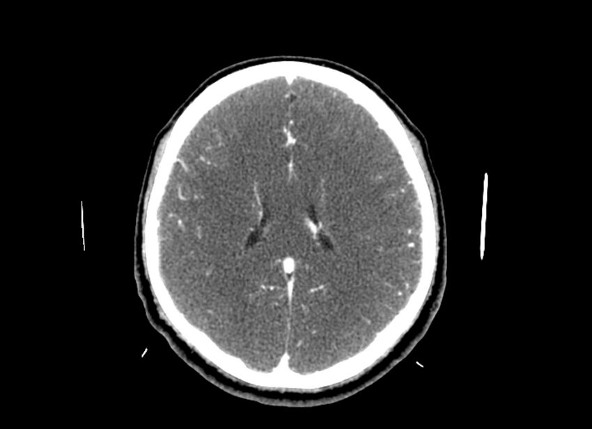 Cerebral edema (Radiopaedia 82519-96661 B 24).jpg
