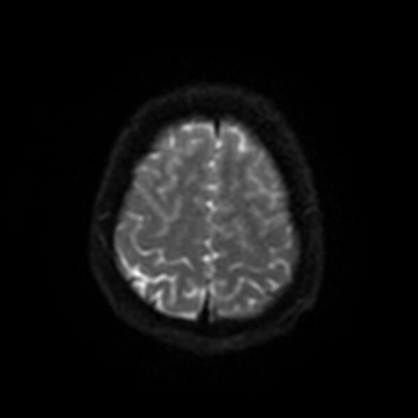 File:Cerebral fat embolism (Radiopaedia 37510-39363 Axial DWI 45).jpg